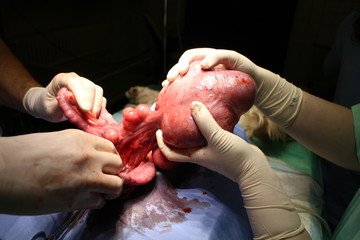 Hysterectomy uterine cancer by American Cocker Spaniel