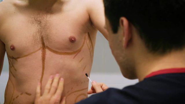 A Plastic Surgeon Draws A Markup For The Operation Of Liposuction And Liposculpture. A Patient Is A Man, A Man's Beauty.