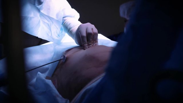 the doctor performs an operation of liposuction to a man. Gathers the fat of the cannula. Cosmetic surgery for a man, improvement of his body