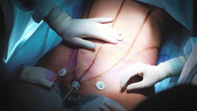 Surgeon and surgical team are performing cosmetic surgery on breasts in hospital operating room. Breast augmentation. Breast enlargement. Liposuction. Emergency care. Surgery detail