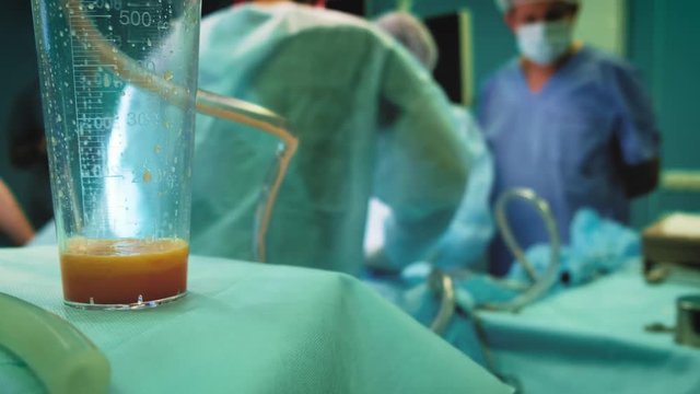 fat removal and Liposuction surgery Fat seeker. human fat in the glass after liposuction. Drain excess calories during surgery.