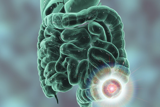 Colorectal cancer awareness medical concept. Concept of cancer treatment and prevention, 3D illustration