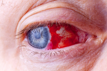 Bloodshot eye. Close-up macro image of a very red bloody eyeball.