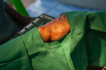 Hand incise wound