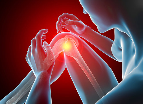 Uomo con dolore al ginocchio, rotula, scheletro e muscoli, 3d rendering. Radiografia
