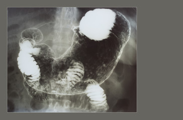 Stomach x-ray with barium contrast medium