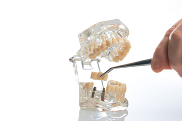 Dental technician placing the fixed partial denture, dental bridge on the screw implants, close-up. Dentists tooth model with screw implant for teaching, learning showing teeth and gums