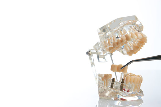 Dental technician placing the fixed partial denture, dental bridge on the screw implants, close-up. Dentists tooth model with screw implant for teaching, learning showing teeth and gums