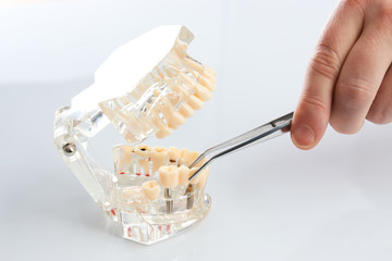 Dental technician placing the fixed partial denture, dental bridge on the screw implants, close-up. Dentists tooth model with screw implant for teaching, learning showing teeth and gums