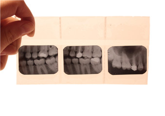 tooth dental radiography film anatomy