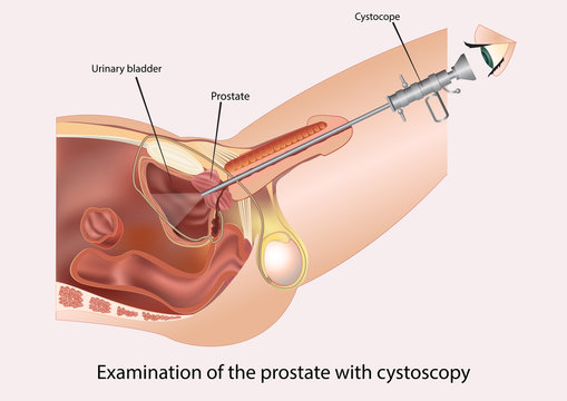 Examination of the prostate with cystoscopy