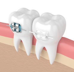 3d render of teeth with ceramic and metal braces
