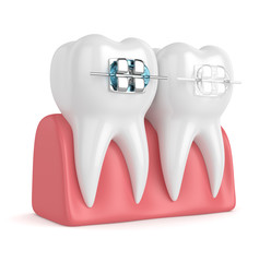 3d render of teeth with ceramic and metal braces