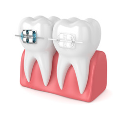 3d render of teeth with ceramic and metal braces