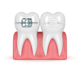 3d render of teeth with ceramic and metal braces