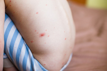 Boy with chicken pox rashon on the back