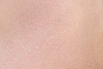 burnt skin sunburn a great extent, the sun, many small blisters closeup