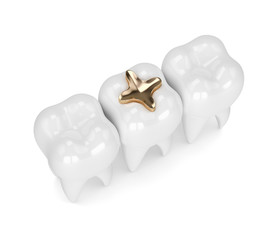 3d render of teeth with dental golden inlay filling