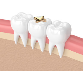 3d render of teeth with dental golden inlay filling