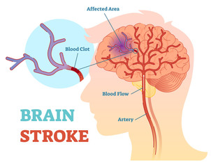 Brain Stroke anatomical vector illustration diagram, scheme 
