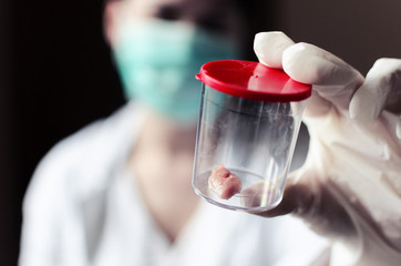 sample of tumors or cancers in the container