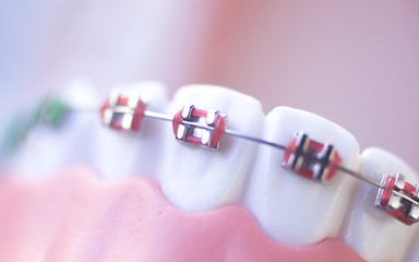 Cosmetic dental metal brackets