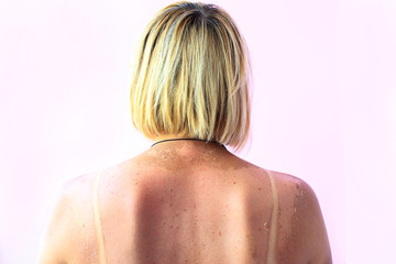 Traces of sunburn on the back of a woman. Female body