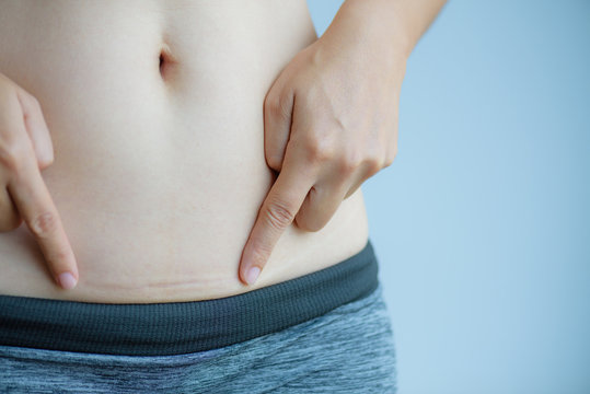 Closeup of woman showing on her belly dark scar from a cesarean section.
