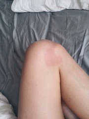 heart shaped sign on skin