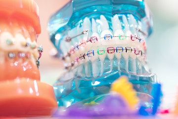 orthodontic model and dentist tool - demonstration teeth model of varities of orthodontic bracket...