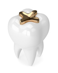 3d render of tooth with dental golden inlay filling