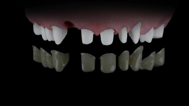 Funktion einer Teleskopprothese  ( Dentallabor )