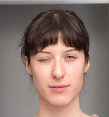 Woman with facial hemiparesis