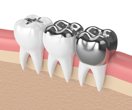 3d render of teeth with different types of dental amalgam filling