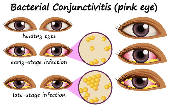 Diagram showing bacterial conjunctivitis in human eye