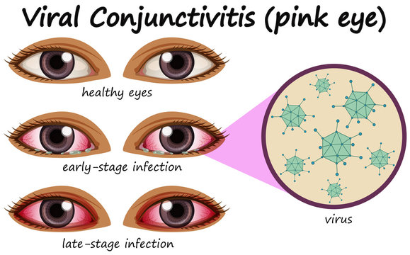 Human eye disease with viral conjunctivitis