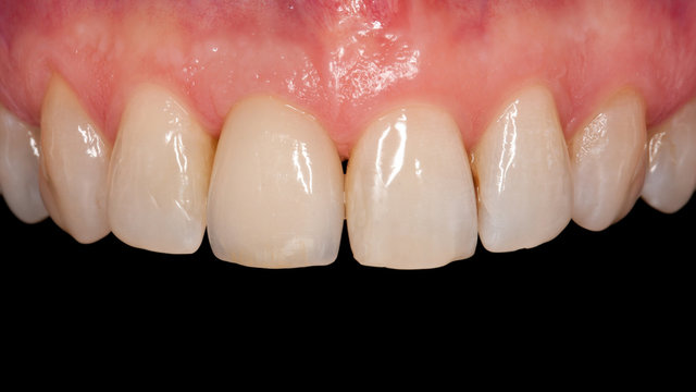 Implantatkrone fertig vor schwarzem Hintergrund isoliert