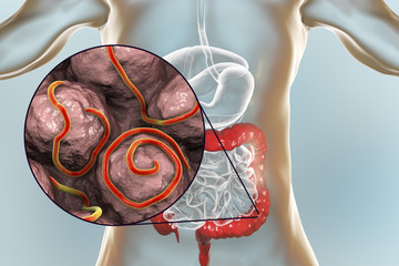 Helminths nematodes Enterobius in the gut. Threadworm which causes enterobiasis, 3D illustration showing close-up view of threadworms located in large intestine