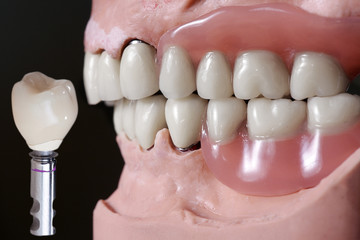 Gebiss mit Implantat Nahaufnahme