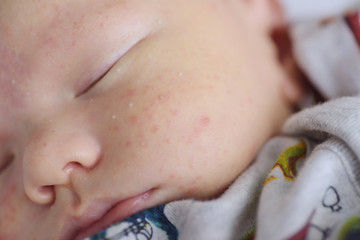 baby rash close  up