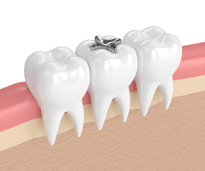3d render of teeth with dental amalgam filling