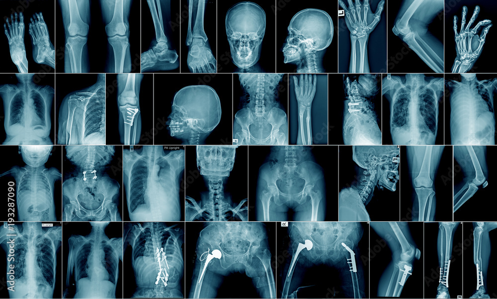 Sticker high quality x-ray collection body part and fracture area