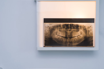Analyzing dental x-ray, tooth x-ray in viewer on the wall.