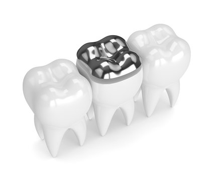 3d render of teeth with dental onlay amalgam filling