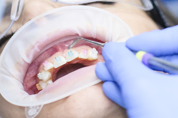 Mouth of dentist's patient close up