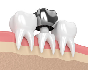 3d render of teeth with dental crown amalgam filling