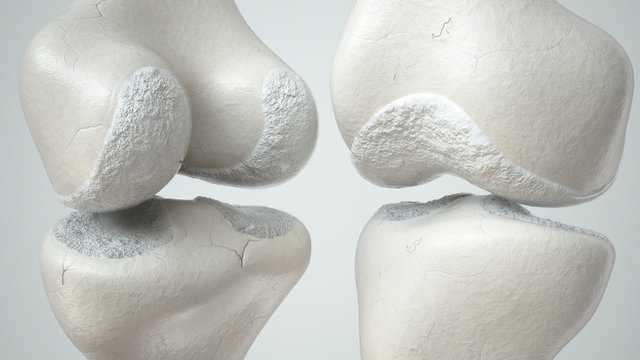 Knee joint with cartilage loss due to Arthose, front and back- 3D Rendering