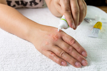 Eczema on the hands. The woman applying the ointment , creams in the treatment of eczema, psoriasis and other skin diseases