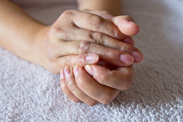 Eczema on the hands . Skin disease