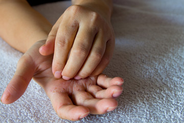 Eczema on the hands . Skin disease causing itching . Woman's hands scratching with eczema